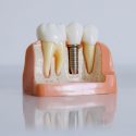Implant Crown Placement